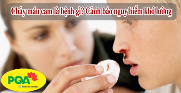 Cách Chữa Dứt Điểm Bệnh Chảy Máu Cam Ở Trẻ Em, Người Lớn